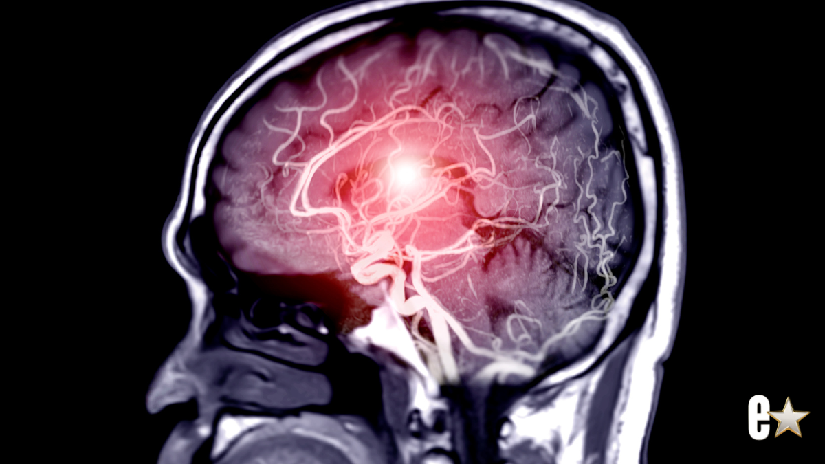 Sandy Duncan Brain Tumor